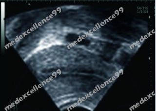 Ultraschallgeräte Ultrasound Scanner Ultraschall Diagnose System
